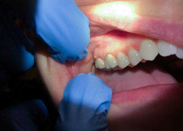 Best Emergency Dentist for Lost Fillings or Crowns in Long Branch, VA